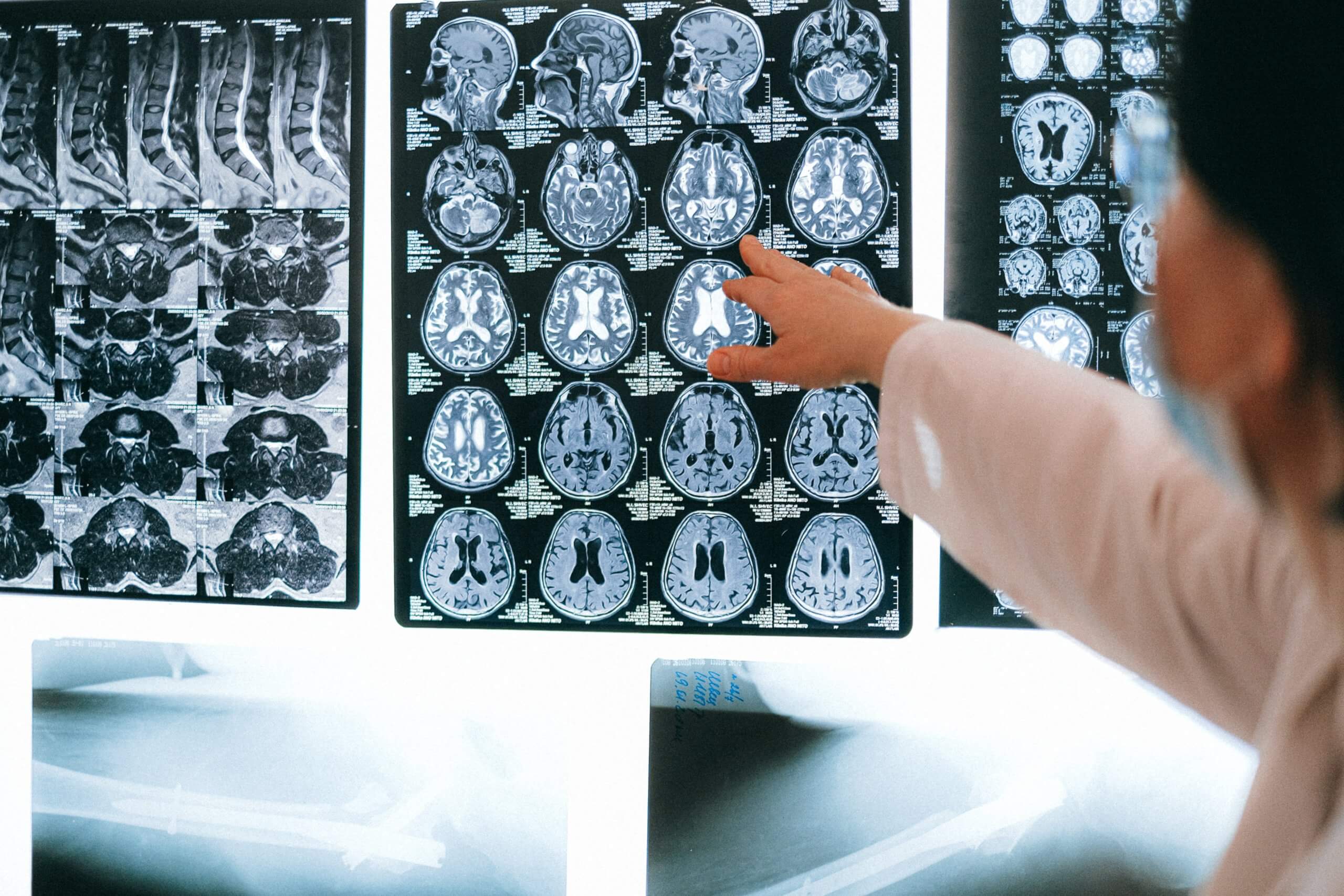 Kip Kingle'S Brain: The Scan That Changed Everything - ebb46hh