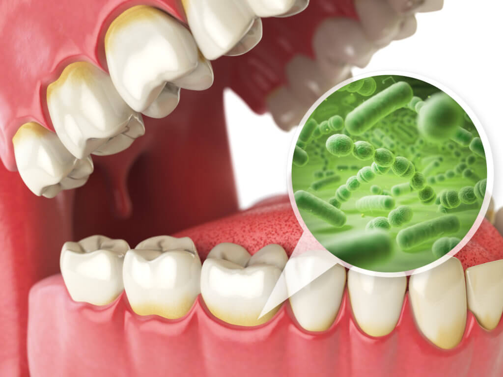 Bacterias and viruses around tooth, gums, gum disease