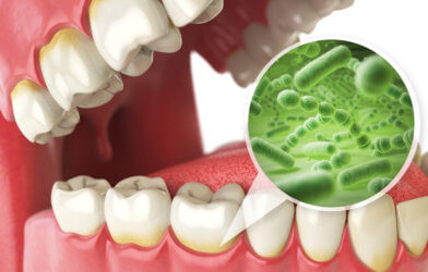 Bacterias and viruses around tooth, gums, gum disease