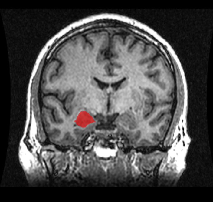 Amygdala on MRI