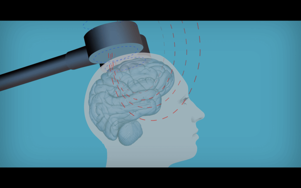 rTMS (Transcranial magnetic stimulation)