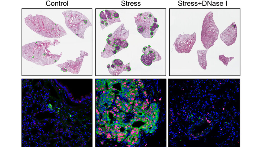 Cancer spread faster and more furiously in stressed mice (middle column) than in a control group (left column). By comparison, cancer cells in stressed mice treated with an enzyme called DNase I (right column) were largely non-proliferating, and the treatment caused a significant reduction in stress-induced metastasis. 