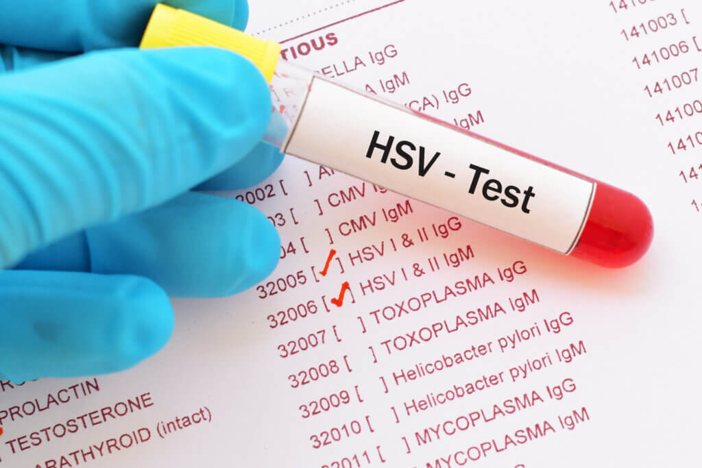 Herpes Simplex Virus (HSV) Blood Test