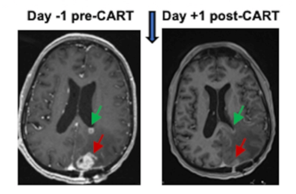 MRI scans taken 24 to 48 hours after the dual-target CAR T cells were administered showed reduced tumor sizes in all six patients, with these reductions being sustained for several months in some cases.